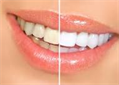 Advance Teeth Whitening